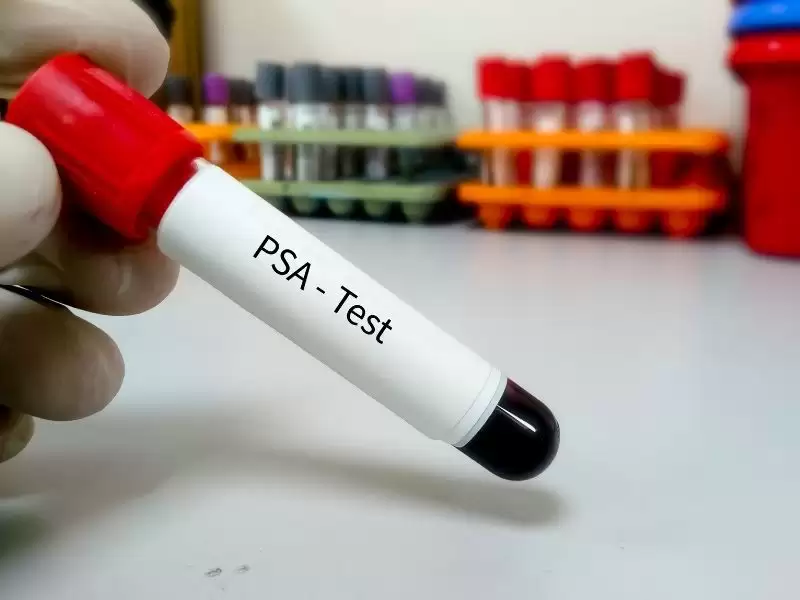 psa-prostat-spesifik-antijen-nedir