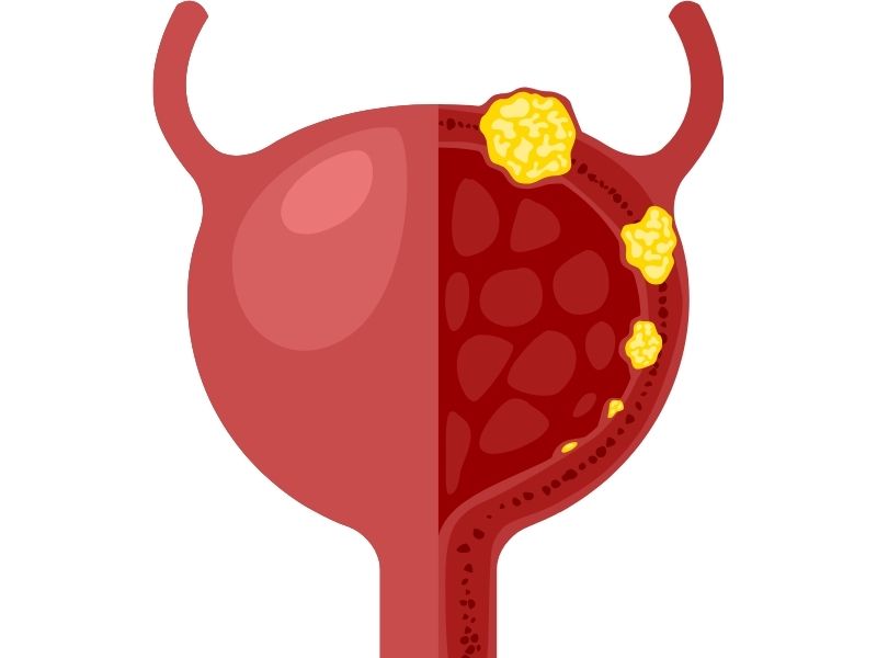 mesane-kanseri-riskini-artirabilen-uzun-sureli-mesane-tahrisi-nedenleri