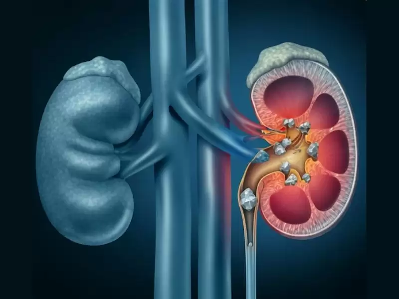 renal-kolik